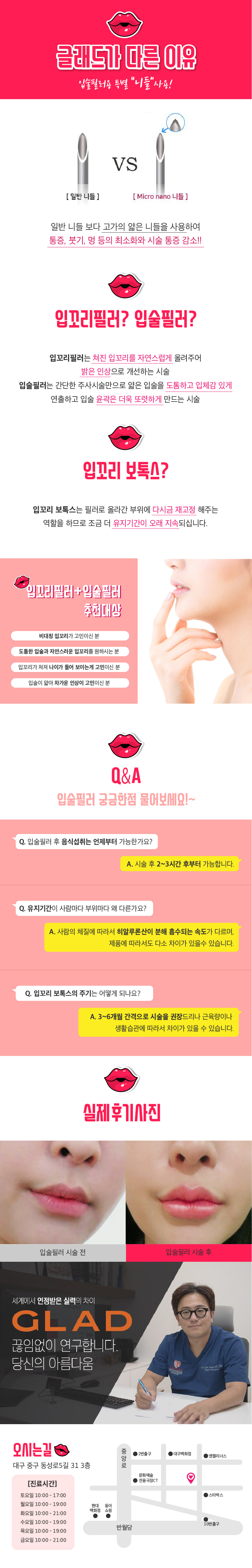 대구 동성로 글래드성형외과의 '말랑말랑푸딩입술필러' 패키지 시술: 입꼬리필러+입술필러+입꼬리보톡스를 20만원에 제공