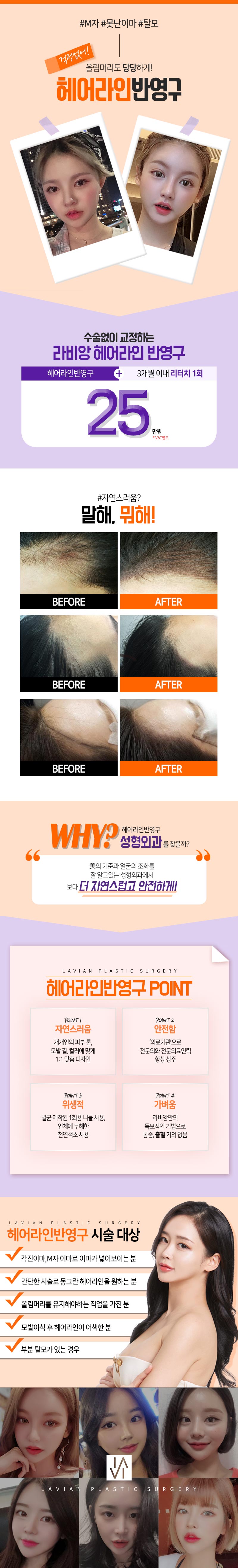라비앙성형외과의 수술없이 자연스러운 헤어라인 교정이 가능한 25만원 반영구 시술