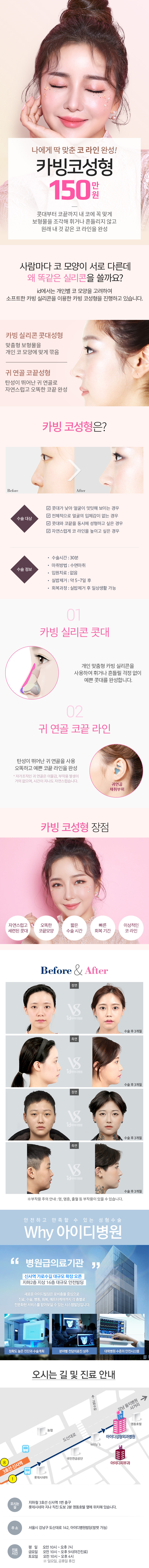 아이디병원의 150만원 카빙코성형 프로모션으로 콧대부터 코끝까지 자연스러운 라인 교정