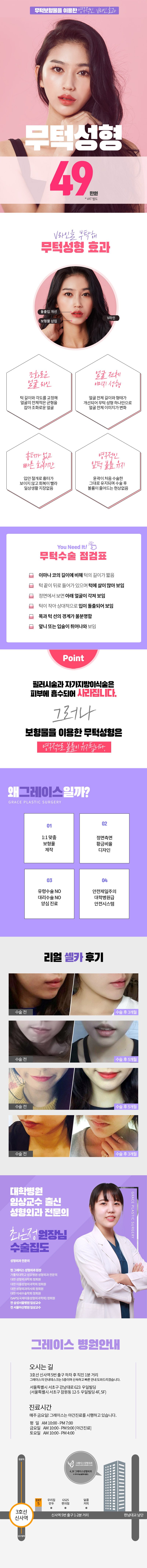 서울 신사동 그레이스성형외과의 49만원 무턱성형 시술로 V라인과 돌출입 개선 효과