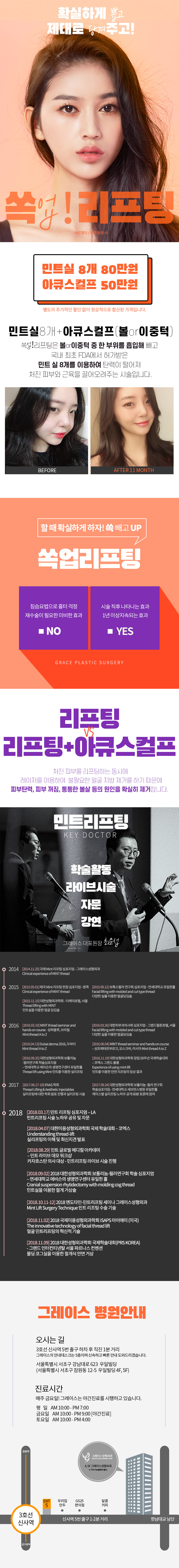 그레이스성형외과의 쏙 빼고_리프팅 UP 시술은 민트실과 아큐스컬프를 결합한 130만원의 효과적인 리프팅 프로그램
