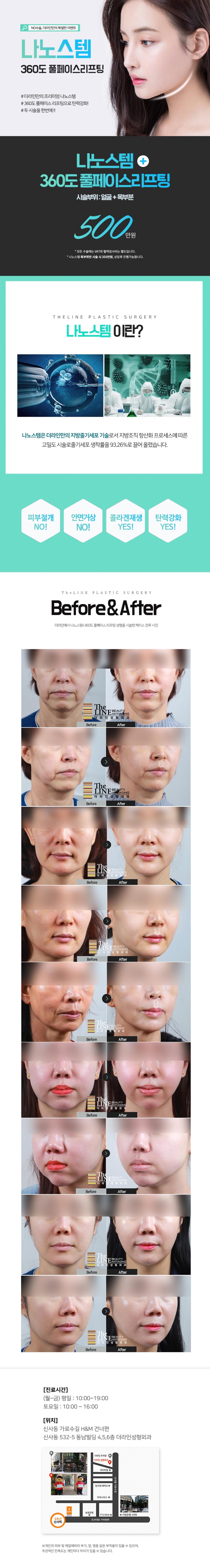 수술 없이 줄기세포를 활용한 360도 풀페이스+목 리프팅 시술로 500만원에 제공되는 프리미엄 안티에이징 프로그램
