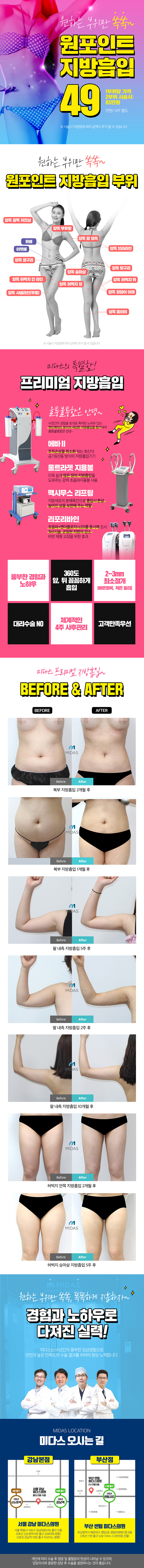 강남 미다스의원의 49만원 원포인트 지방흡입 시술로 팔, 허벅지, 복부 등 원하는 부위만 선택적으로 시술 가능