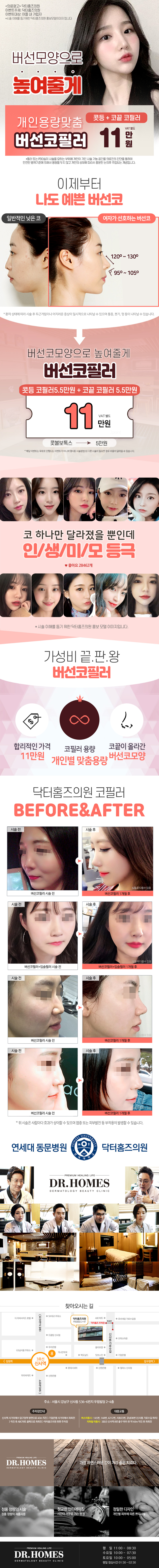 서울 신사동 닥터홈즈의원의 개인맞춤형 버선코 성형 시술 (11만원)