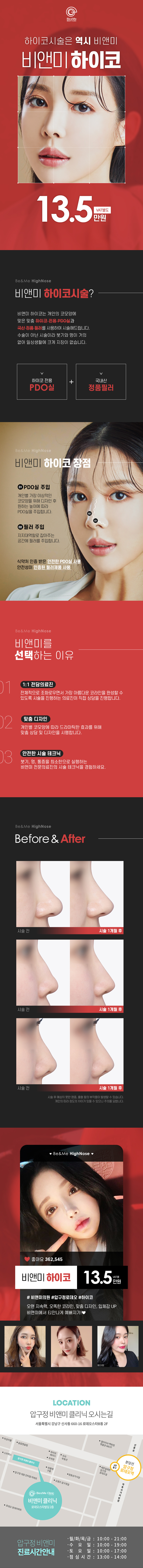 압구정비앤미의원의 정품 하이코 시술로 셀카각 코 성형 13.5만원 특가 프로모션