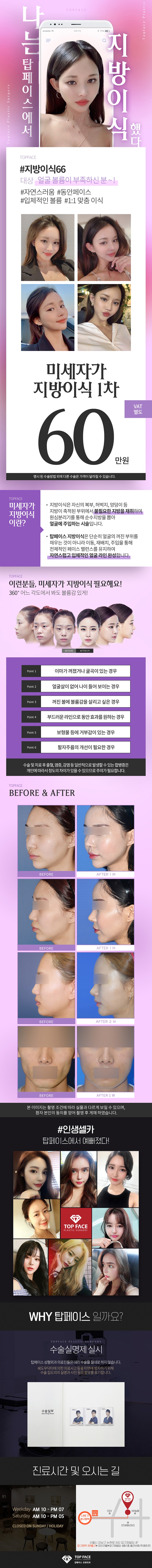 압구정 탑페이스성형외과의 60만원 지방이식 프로모션으로 자연스러운 볼륨감 형성