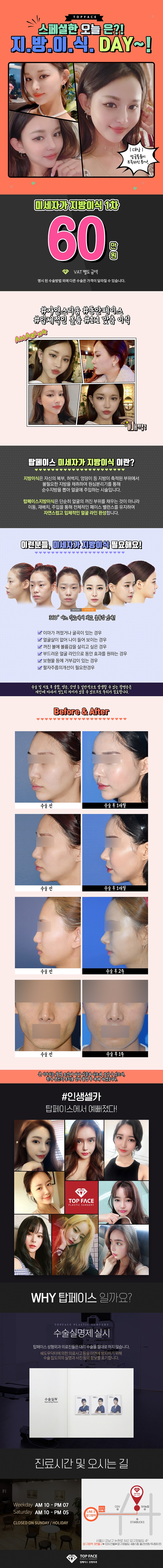 압구정 탑페이스성형외과의원의 60만원 특가 지방이식 이벤트 진행
