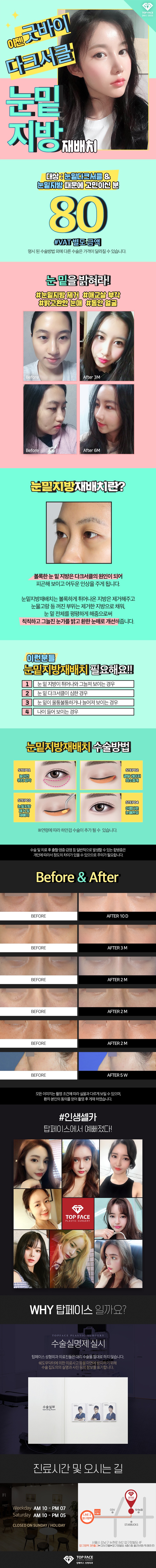 압구정 탑페이스성형외과의 80만원 눈밑지방재배치 시술로 다크써클과 눈밑지방 고민 해결