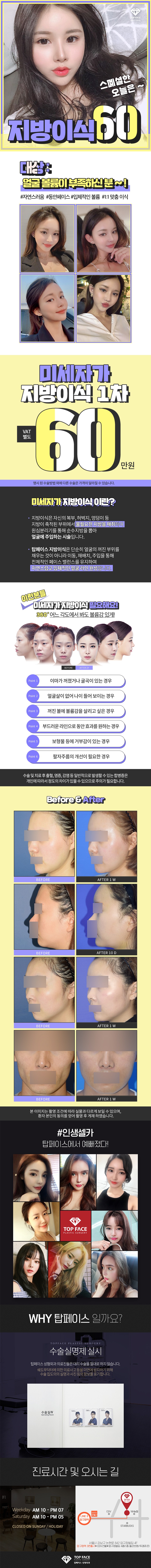 탑페이스성형외과의원의 60만원 스페셜 지방이식 프로모션 - 자연스러운 볼륨감 형성을 위한 특별 이벤트