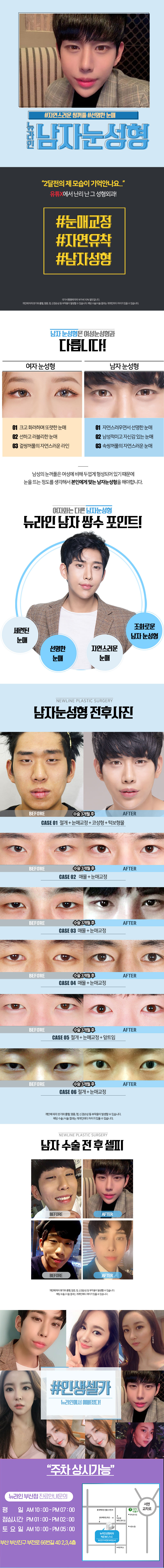 부산 서면 뉴라인성형외과의 남자 맞춤 쌍꺼풀 수술 70만원 특별 프로모션