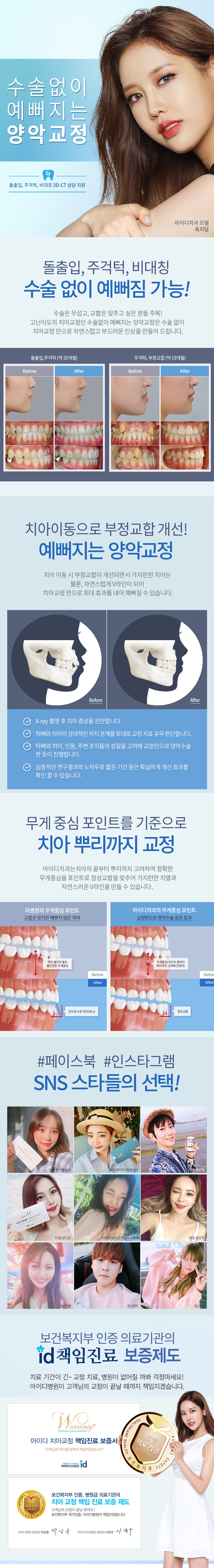 서울 신사동 아이디치과의 수술 없는 양악교정 시술(450만원)로 자연스러운 턱 라인과 치아 교정 가능