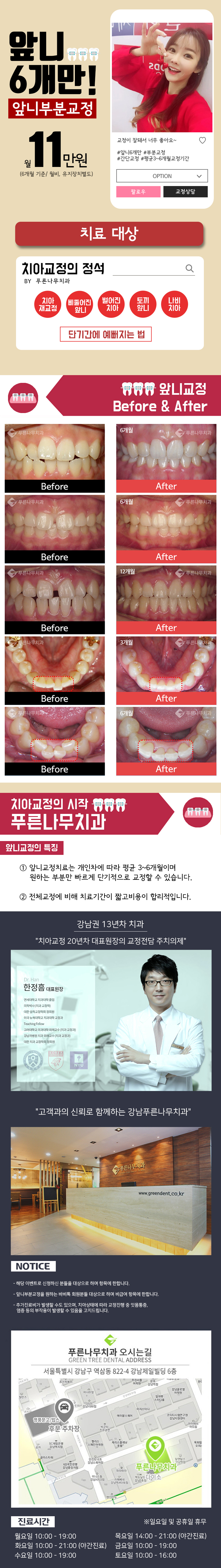 서울 강남 푸른나무치과의 앞니 단기교정 6개월 프로그램 (66만원)
