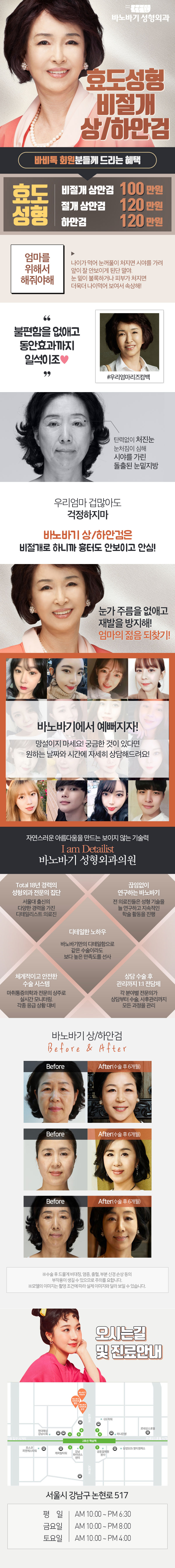 서울 교대 바노바기성형외과의원의 비절개상안검 100만원 효도성형 프로모션
