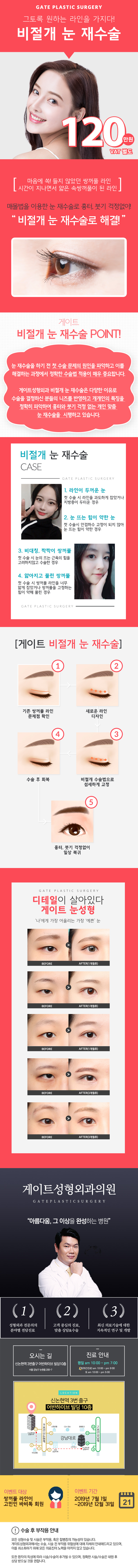 강남 게이트성형외과의 비절개 눈재수술 120만원 특별 프로모션, 흉터와 붓기 최소화 강조
