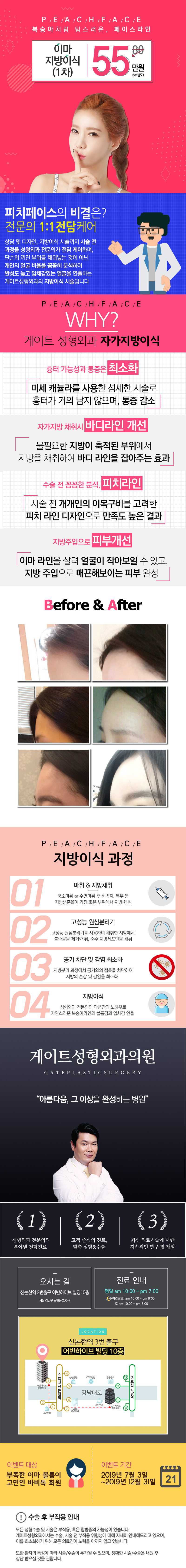 게이트성형외과의 피치페이스 이마 지방이식 시술로 복숭아처럼 자연스러운 이마 볼륨을 55만원에 완성
