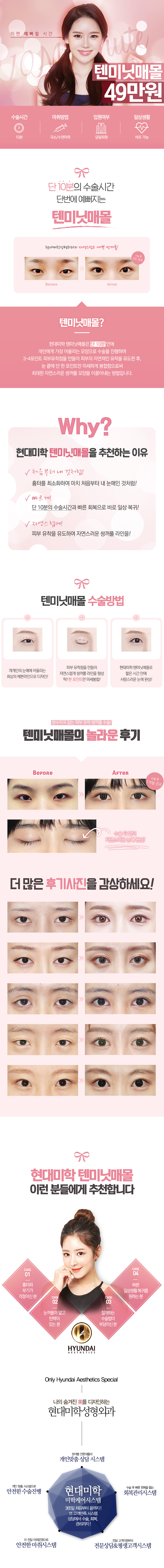 현대미학성형외과의 10분 만에 완성하는 매몰법 쌍꺼풀 수술, 49만원 특가 프로모션