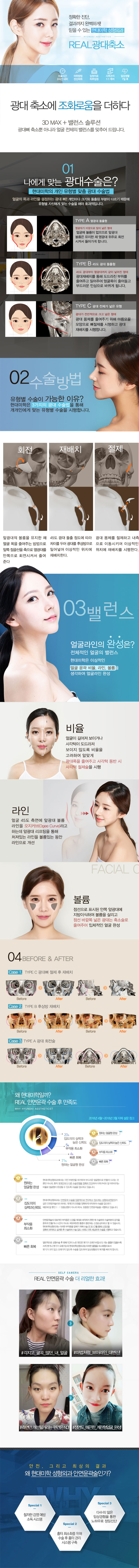 서울 신사동 현대미학성형외과의 FULL광대축소 패키지 250만원 특가 프로모션(앞광대+옆광대+45도광대 포함, 검사비 및 사후관리 포함)