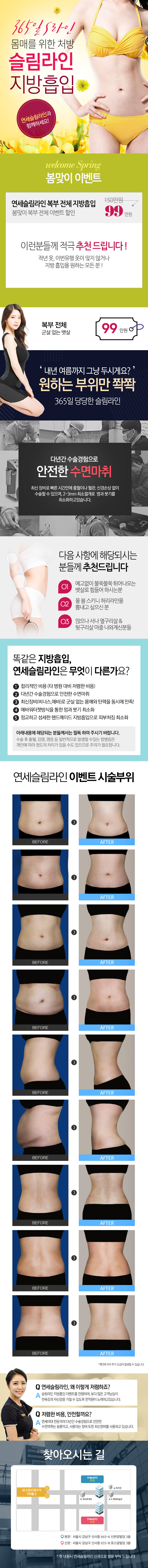 서울 교대 연세슬림라인의 복부지방흡입 전체시술 99만원 특가 프로모션(검사비 무료, 상복부/하복부/옆구리 포함)