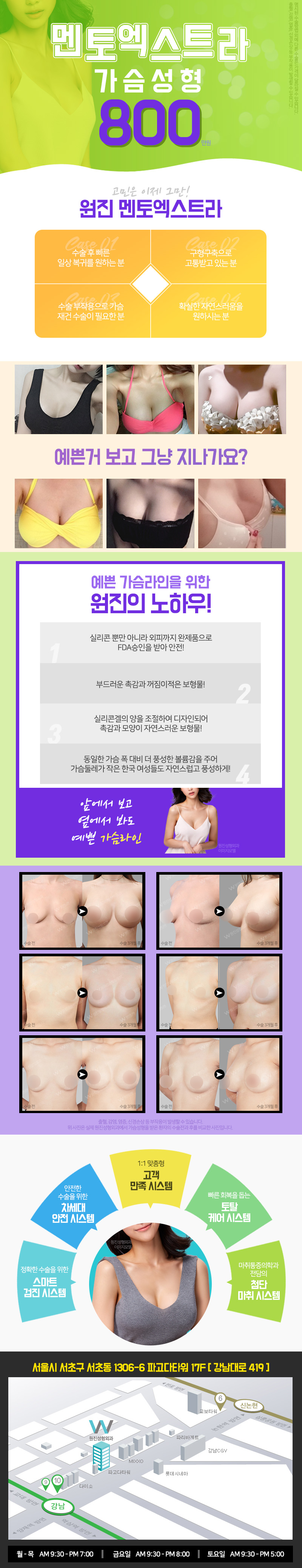 원진성형외과의 프리미엄 가슴성형 '멘토엑스트라' 800만원 특별 프로모션