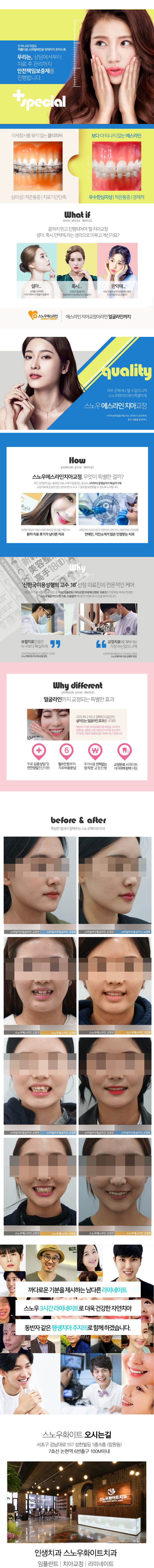 스노우화이트치과의 에스라인 치아교정 - 수술없이 진행되는 맞춤형 치아교정 시스템 (20만원)