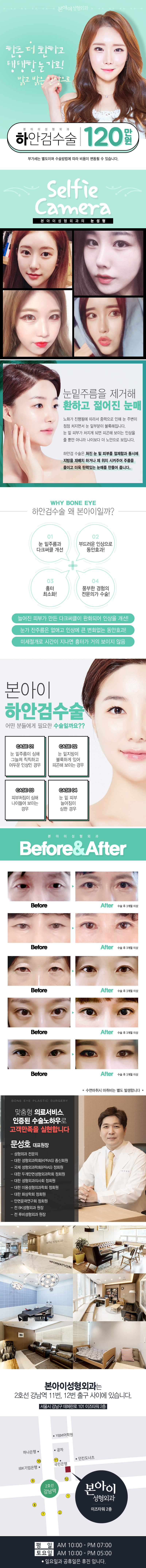서울 강남 본아이성형외과의 하안검 수술(120만원) - 처진 눈밑을 매끈한 동안 눈매로 개선하는 시술