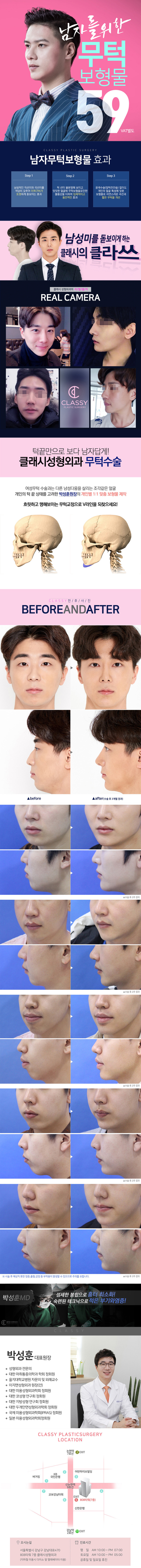 서울 교대 클래시성형외과의 남성 특화 무턱보형물 수술 59만원 특가 프로모션
