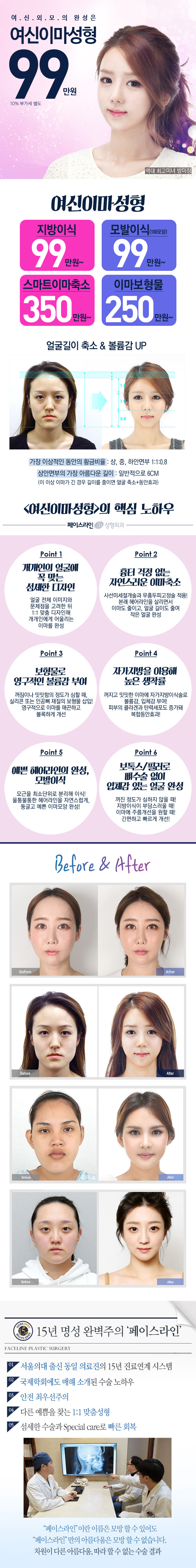 압구정 페이스라인성형외과의 이마성형 시술 99만원 특가 프로모션(지방이식/모발이식, 이마축소, 이미보형물 포함)