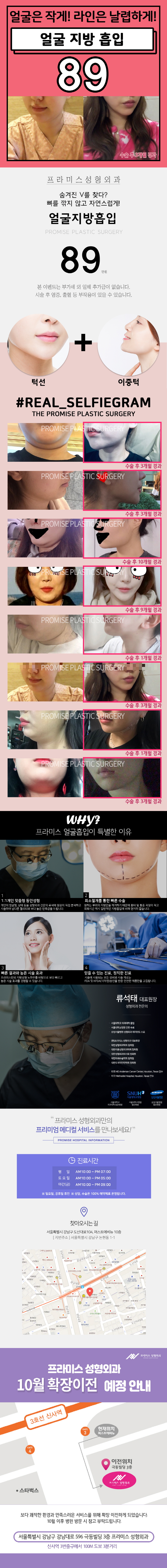 서울 신사동 프라미스성형외과의 89만원 얼굴 지방흡입 시술로 V라인 완성