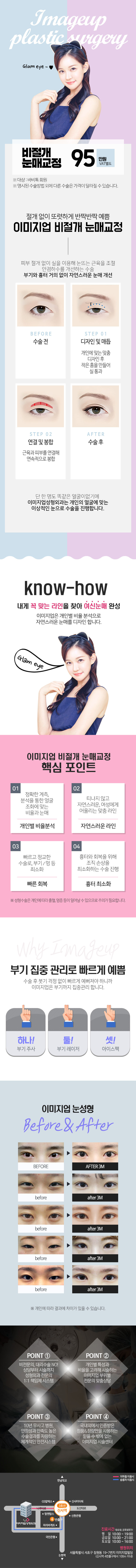 서울 신사동 이미지업성형외과의 절개없이 자연스러운 눈매 교정 시술(95만원)