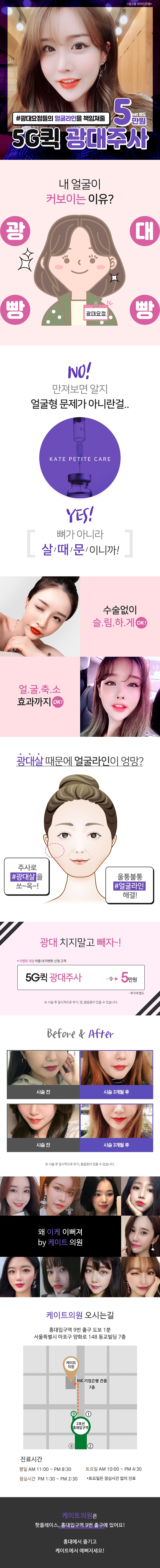 서울 교대 케이트의원의 비수술 광대축소 5G퀵광대주사 5만원 특가 프로모션