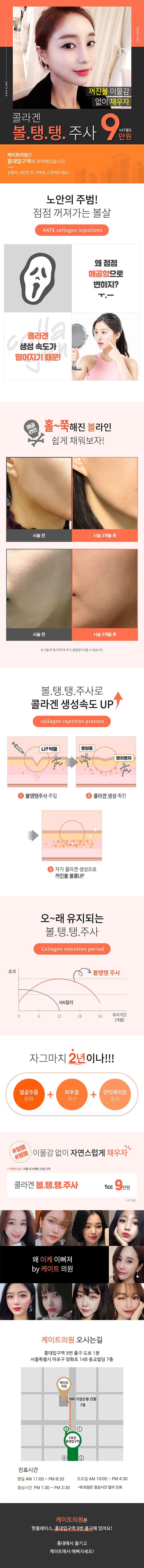 서울 교대 케이트의원의 볼탱탱주사 시술로 이물감 없이 자연스러운 볼륨감 형성 (9만원)