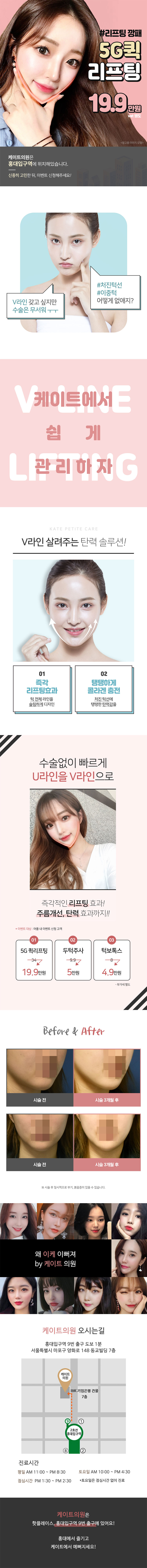 서울 교대 케이트의원의 5G 퀵리프팅 시술로 즉각적인 탄력 개선과 V라인 교정 (19.9만원)