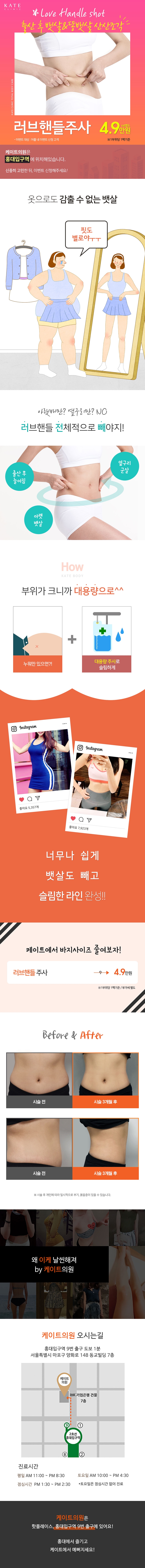 서울 교대 케이트의원의 러브핸들주사 시술로 똥뱃살 개선 및 바디라인 교정 (49,000원)