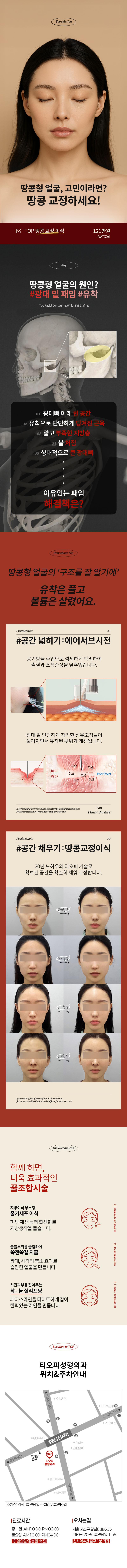 땅콩얼굴 교정을 위한 지방이식 시술로 단순 볼륨 증가가 아닌 구조적 교정을 제공하는 신사동 소재 티오피성형외과의원의 특화 시술