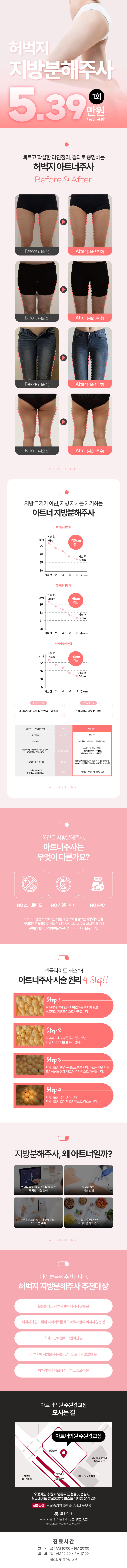 아트너의원(광교점)에서 진행하는 오픈특가_허벅지라인아트는 지방분해주사로, 허벅지 균형감 있는 바디라인을 개선시켜주는 시술입니다.