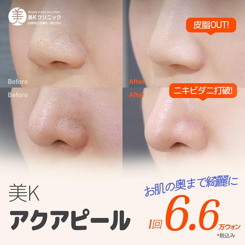 美K 1対1オーダーメイド 角質＆毛穴掃除_アクアピール 1回