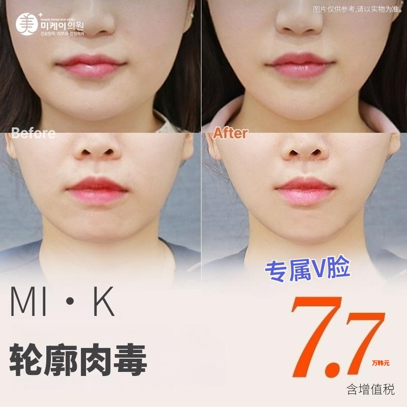 米凯 V脸轮廓瘦脸针