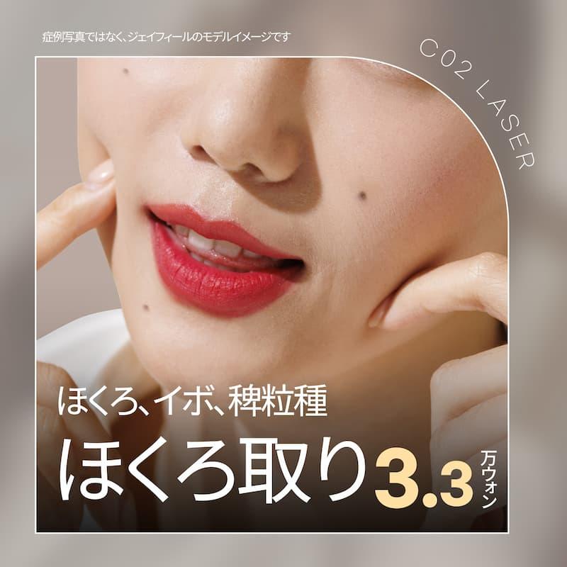 ほくろ,イボ,稗粒種  ほくろ取り