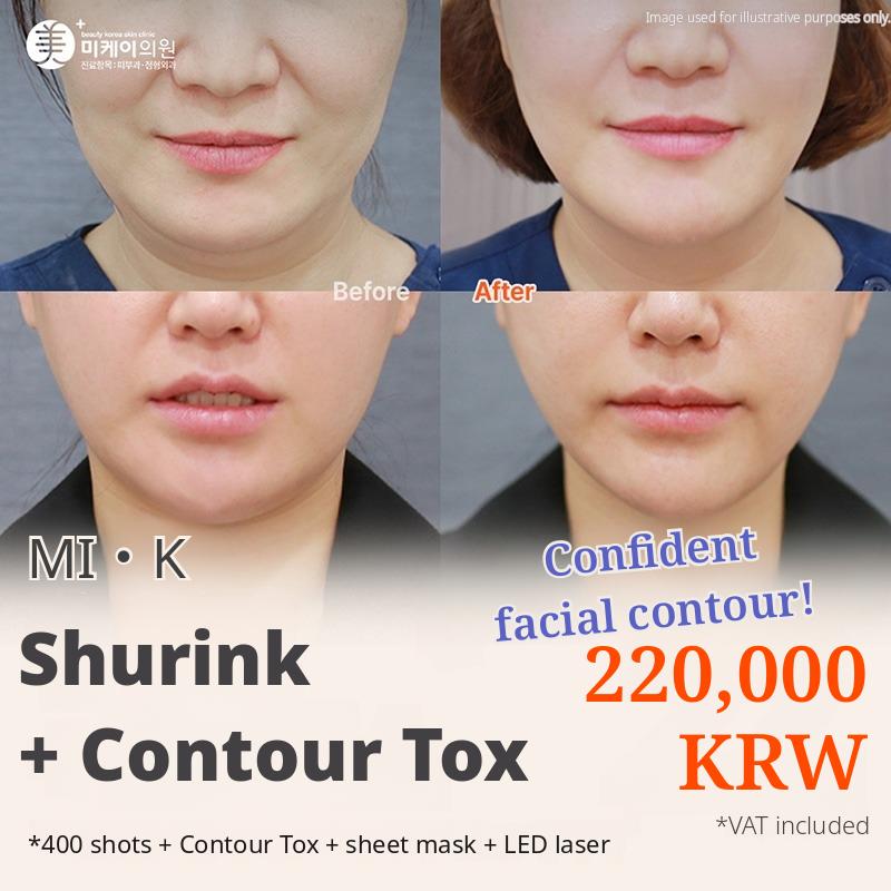 MI.K Shurink & Contouring Botox