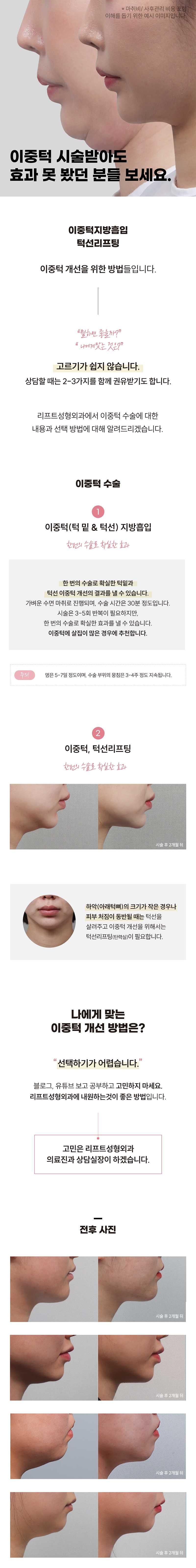 대구 동성로 리프트성형외과의 얼굴지방흡입 시술: 77만원으로 이중턱, 볼살 개선