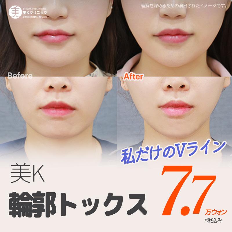 美K Vライン輪郭トックス