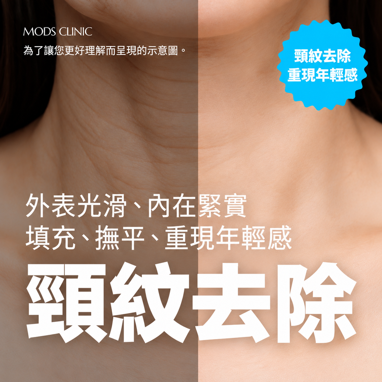 清潭頸紋去除療程