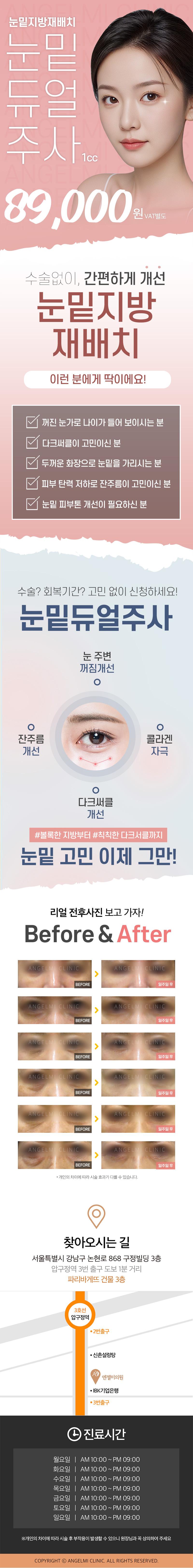 압구정 엔젤미의원의 눈밑듀얼주사 시술로 수술 없이 빠르게 눈밑지방 재배치가 가능한 8.9만원 특가 프로모션