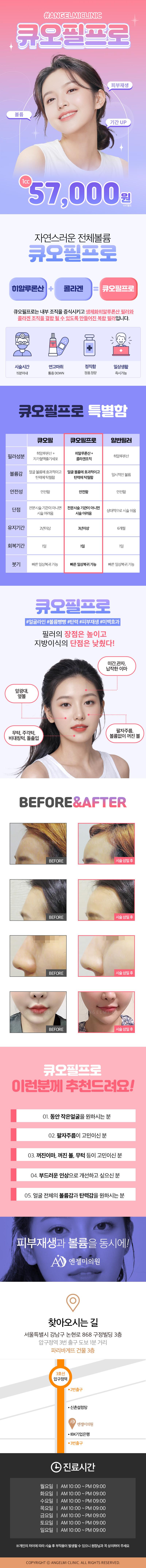 엔젤미의원의 큐오필프로 시술로 꺼진 볼과 팔자주름 개선, 자연스러운 볼륨감 회복(57,000원)