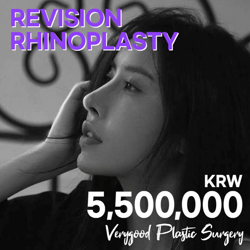 VERYGOOD REVISION RHINOPLASTY
