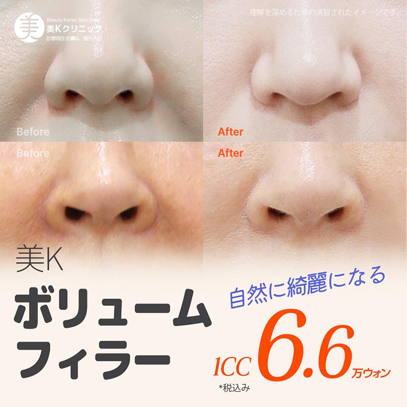 美K 自然なオーダーメイドフィラー_唇、顎先、ほうれい線