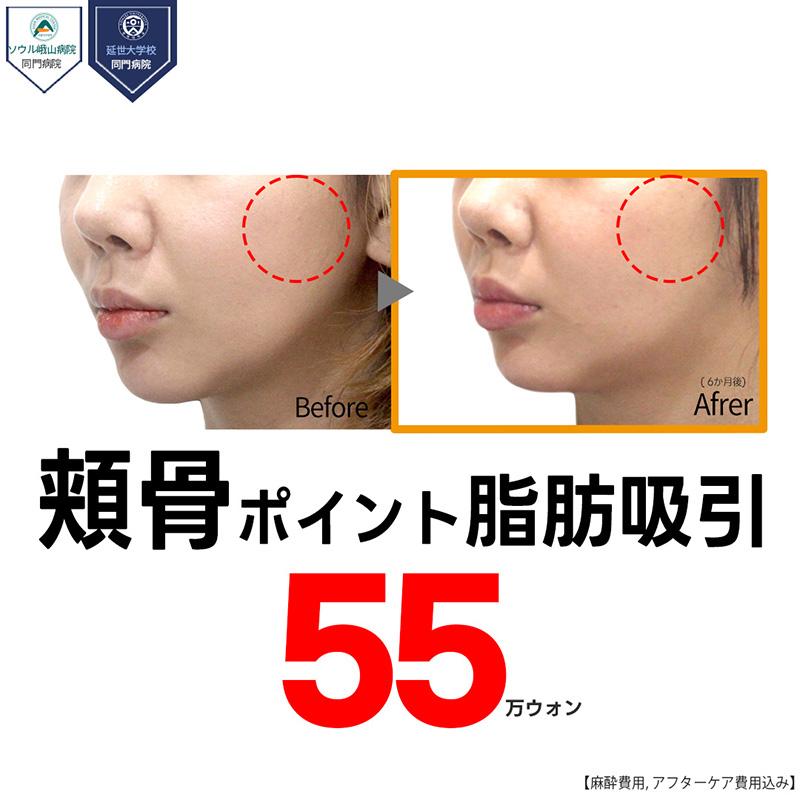 顔の脂肪吸引_頬骨ポイント