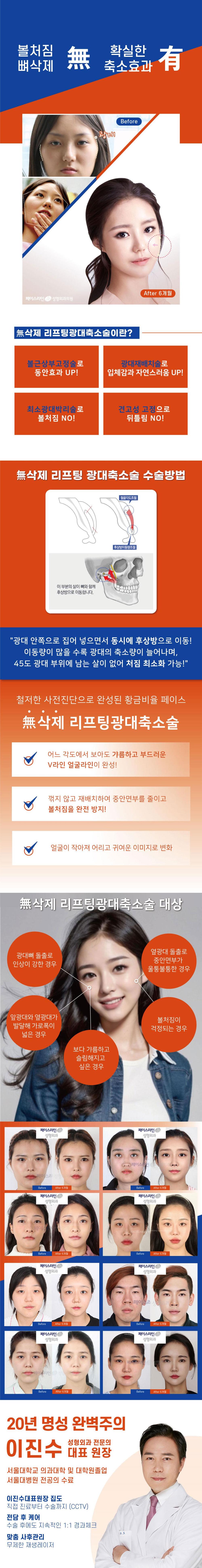 압구정 페이스라인 성형외과의 무삭제 리프팅 광대축소술로 뼈 절제 없이 자연스러운 광대축소 효과