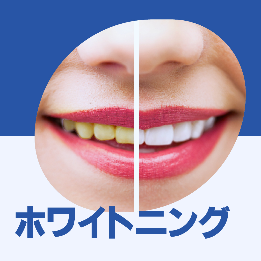 ホワイトニング