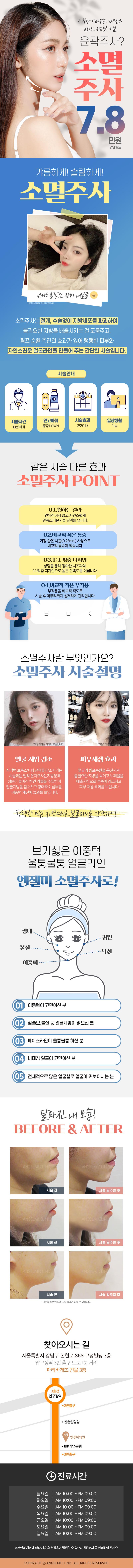 서울 압구정 엔젤미의원의 V라인 윤곽 개선을 위한 소멸주사 시술 (7.8만원)